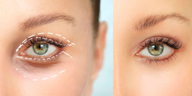 Блефаропластика