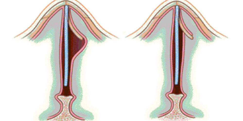 септопластика-носа