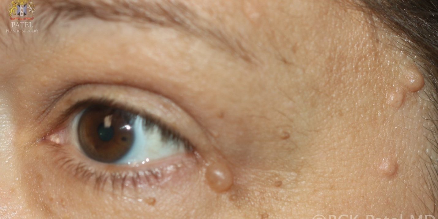 АКРОХОРДОН, НИТЕВИДНАЯ БОРОДАВКА (acrochordon)