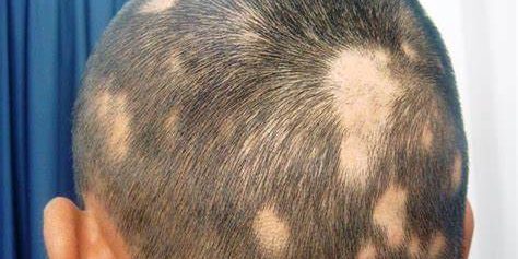 АЛОПЕЦИЯ КРУГОВИДНАЯ, или ГНЕЗДНАЯ ПЛЕШИВОСТЬ АЛОПЕЦИЯ КРУГОВИДНАЯ, или ГНЕЗДНАЯ ПЛЕШИВОСТЬ