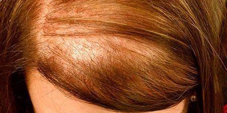 АЛОПЕЦИЯ ЖЕНСКАЯ АНДРОГЕННАЯ