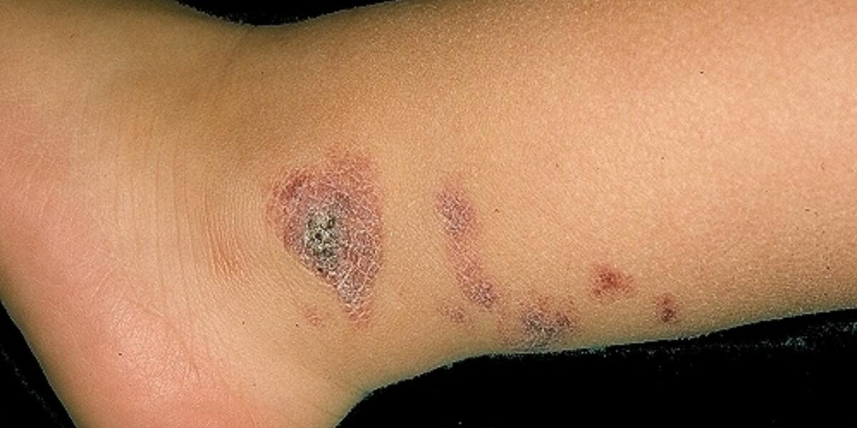 АНГИОКЕРАТОМА МИБЕЛЛИ АНГИОКЕРАТОМА МИБЕЛЛИ