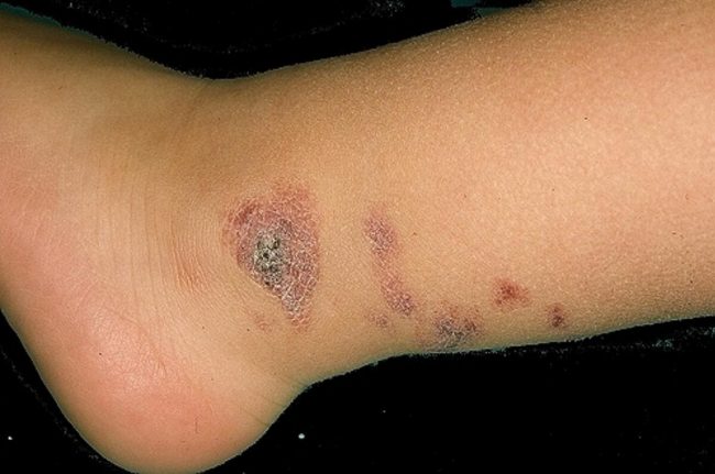 АНГИОКЕРАТОМА МИБЕЛЛИ