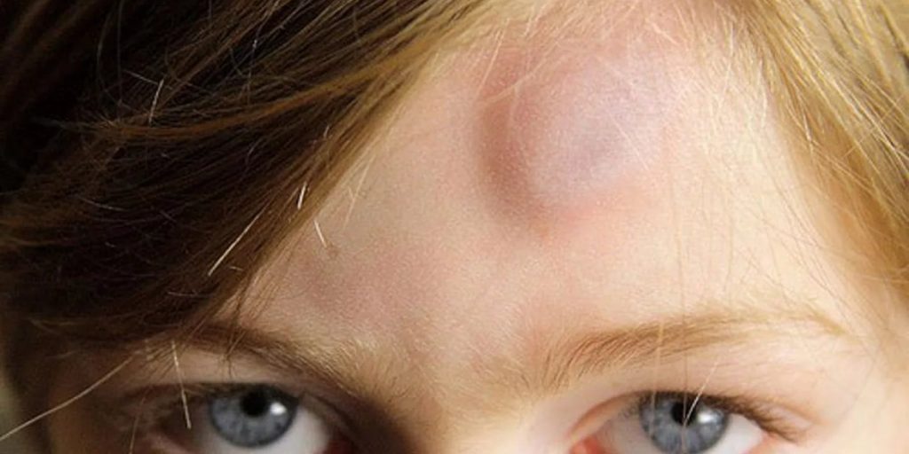 АТЕРОМА, КИСТА САЛЬНОЙ ЖЕЛЕЗЫ, СТЕАТОМА АТЕРОМА, КИСТА САЛЬНОЙ ЖЕЛЕЗЫ, СТЕАТОМА (atheroma)