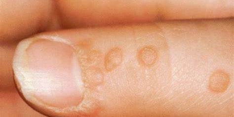 БОРОДАВКИ (verrucae) БОРОДАВКИ (verrucae).