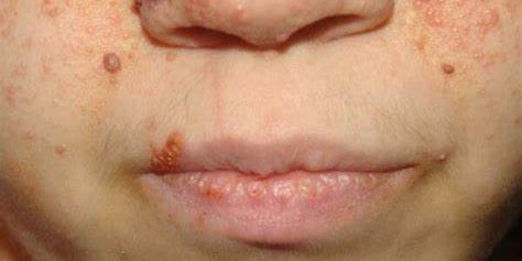 АДЕНОМА СИММЕТРИЧНАЯ САЛЬНЫХ ЖЕЛЕЗ, БОЛЕЗНЬ ПРИНТГЛЯ