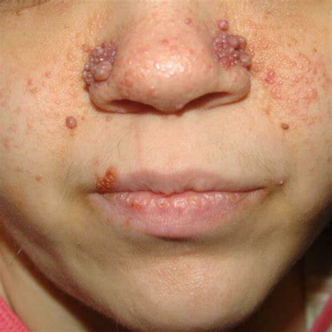 АДЕНОМА СИММЕТРИЧНАЯ САЛЬНЫХ ЖЕЛЕЗ, БОЛЕЗНЬ ПРИНТГЛЯ